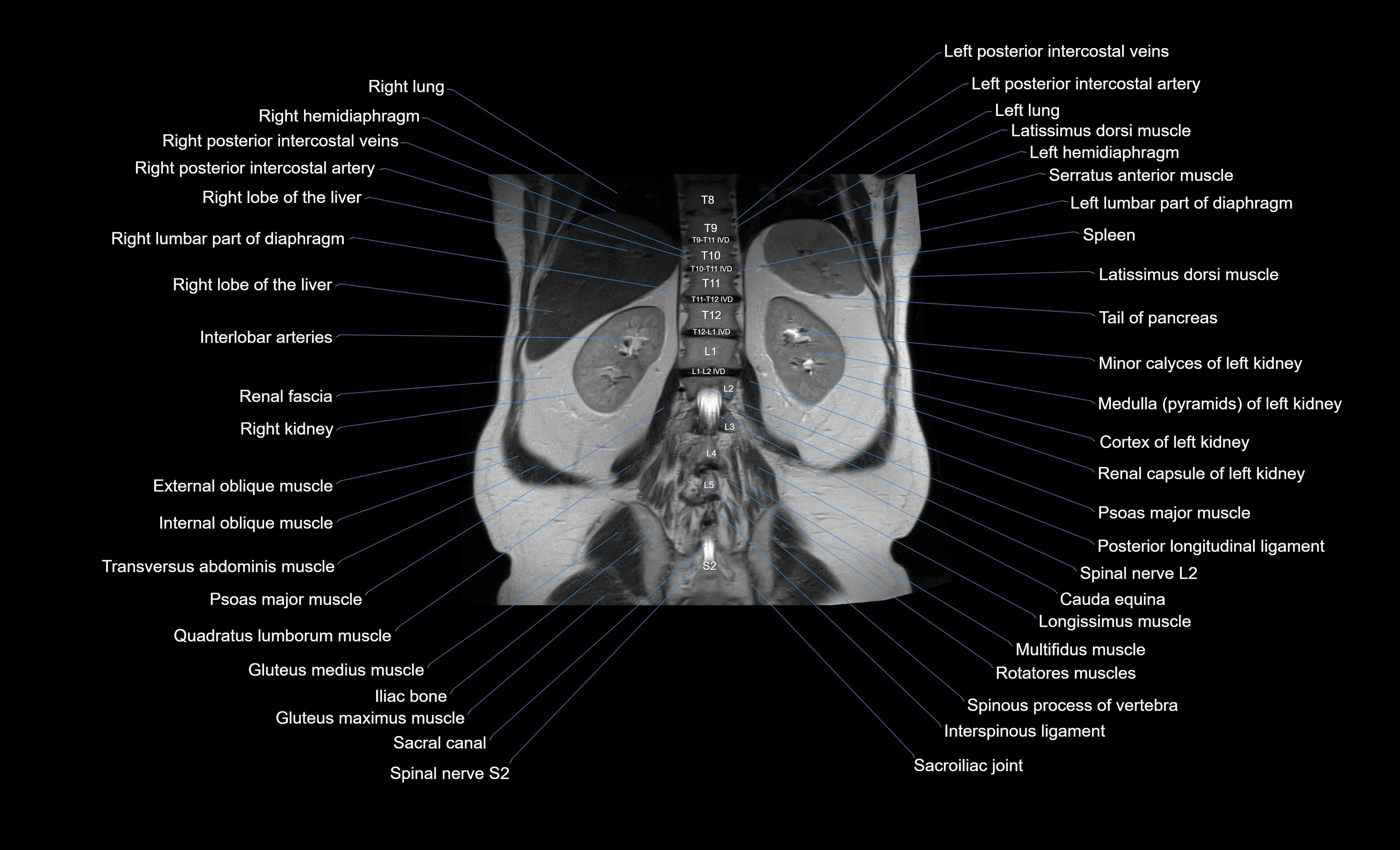 MRI Abdomen coronal labelled cross sectional anatomy radiology  image-img-00001-00043.webp